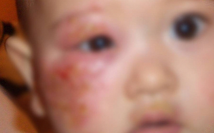 Bé gái 4 tuổi mắc giang mai - nguồn lây không ngờ từ một thói quen cho cháu ăn của bà nội