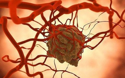 Vượt qua ung thư gan, đây là căn bệnh ung thư có tỷ lệ mắc cao số 1 ở người Việt: Có tính di truyền