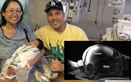 Phép màu y khoa: Em bé chào đời sau 9 tháng phát triển ngoài tử cung, người mẹ không hề biết bản thân mang thai