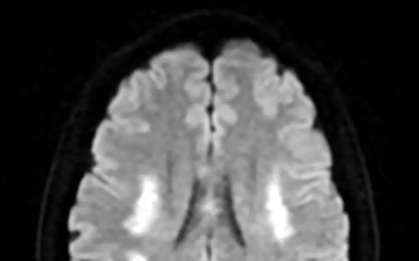 Nữ bệnh nhân đột quỵ bác sĩ chỉ ra nguyên nhân bất ngờ