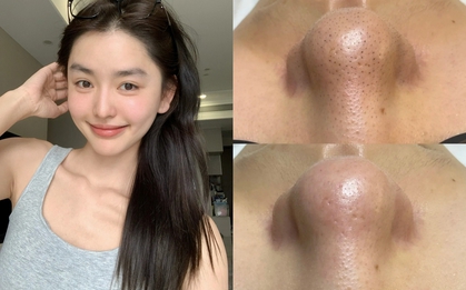 Loại mặt nạ giúp làm sạch sâu lỗ chân lông, nhưng khuyến cáo chỉ nên dùng 1 lần/tuần