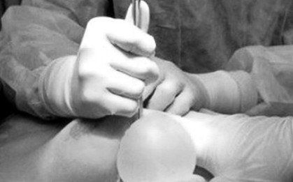 Người phụ nữ 30 tuổi bị hoại tử ngực vì tiêm chất làm đầy