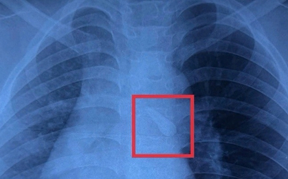 Gắp răng trong đường thở, cứu bé trai 10 tuổi sau tai nạn