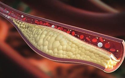 Máu nhiễm mỡ nguy hiểm thế nào?
