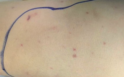 Những triệu chứng ban đầu dễ bị bỏ qua của bệnh do não mô cầu