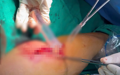 Cảnh báo áp xe sau tiêm truyền tại cơ sở không đảm bảo