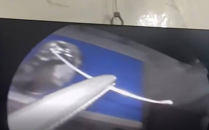 Người đàn ông đau họng dữ dội, bác sĩ gắp ra thứ "đáng sợ" bên trong