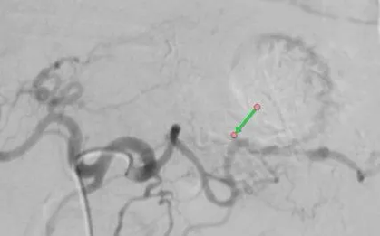 Cầm máu thành công ca ung thư dạ dày biến chứng