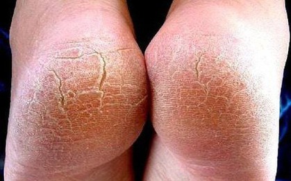 Đừng bỏ qua: 5 dấu hiệu ở bàn chân cảnh báo sức khỏe có vấn đề!
