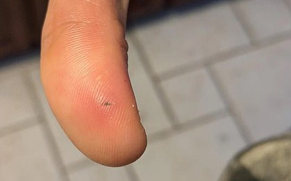 Bị mảnh hành khô găm vào ngón tay, người phụ nữ suýt mất mạng vì điều không ai ngờ tới