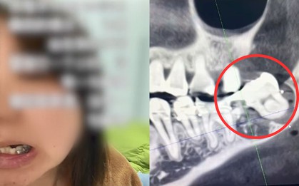 Đi nhổ răng khôn bị bác sĩ nhổ nhầm răng thật, người phụ nữ có lựa chọn tiêu cực