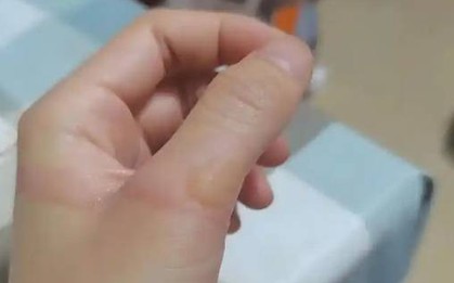 Bé trai 3 tuổi bị bỏng nước sôi 100 độ C, hành động của người bà trong “60 giây vàng” được bác sĩ khen ngợi