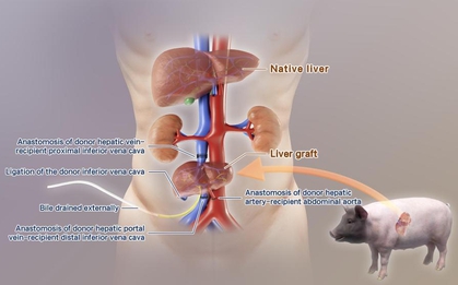 Trung Quốc cấy ghép thành công gan lợn chỉnh sửa gen vào cơ thể người