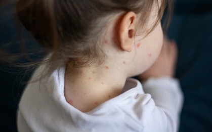 Bị bệnh sởi một lần rồi có thể bị mắc lại nữa không?