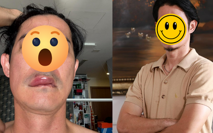 Sao nam Vbiz phát hoảng vì mặt biến dạng, sưng phồng bất thường