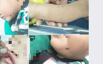 Nữ giáo viên đánh trẻ dã man: Kết quả điều tra ban đầu từ Công an Quảng Nam