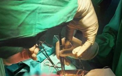 Bé trai 3 tuổi nôn ra giun, đến khi phẫu thuật bác sĩ càng bất ngờ