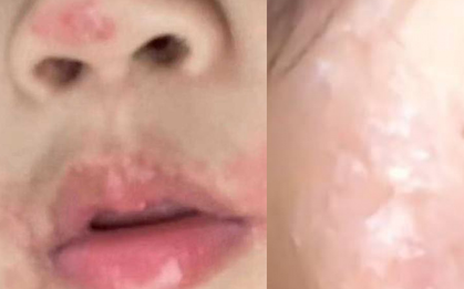 Đi hát karaoke, người phụ nữ nhiễm loại virus không thuốc nào chữa khỏi