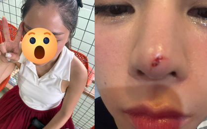 Thêm sao nữ Vbiz gặp tai nạn trên sân pickleball, vết thương chảy máu giữa mặt