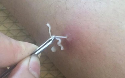 Bệnh do giun rồng tái xuất ở Việt Nam: ‘Sát thủ thầm lặng’ trở lại sau 20 năm