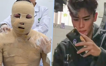 Chàng trai khôi ngô bị bỏng 90% do xe đạp điện Trung Quốc nổ khi sạc, bạn cùng phòng có hành động phẫn nộ