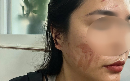 Kết quả giám định vụ cô gái cầu cứu sau khi bị bạn cùng phòng trọ hành hung rách tai vì lấy nhầm nồi nấu ăn