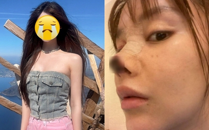 Mỹ nhân 9X bị hoại tử, rụng chóp mũi vì gặp biến chứng thẩm mỹ kinh hoàng nhất showbiz giờ ra sao?