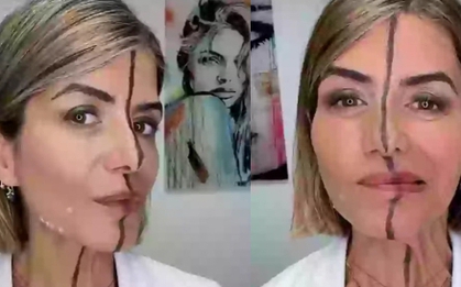 Nữ bác sĩ tiêm botox nửa khuôn mặt để chứng minh tác hại của cách làm đẹp này