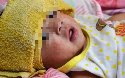 Điều gì xảy ra nếu trẻ chỉ tiêm 1 mũi vắc xin sởi mà không tiêm mũi 2?