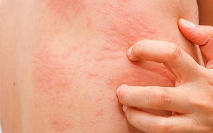 Hà Nội: Nhiều người lớn, trẻ em bị bọ chét đốt phải đi bệnh viện