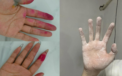 Khuyên thật: Khi làm 7 việc này nhất định phải đeo găng tay, nếu không thì "rước bệnh vào người"