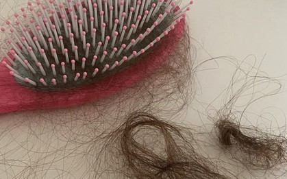 Nguy cơ tóc rụng lả tả vì nắng: 6 dấu hiệu không thể bỏ qua!