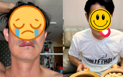 Sao nam Vbiz hoảng hốt vì bị biến dạng mặt: Hé lộ tình trạng nghiêm trọng hiện tại