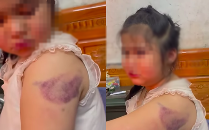 Clip 32 giây vụ học sinh lớp 1 nghi bị cô giáo đánh bầm tím tay vì viết chữ xấu