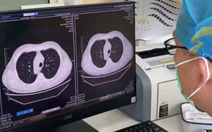 Cảm lạnh và ho, phổi trái của nam sinh đột nhiên "biến mất": Bác sĩ tiết lộ nguyên nhân nhiều người phải cẩn thận