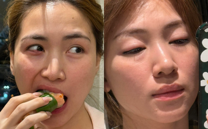 Hoà Minzy lộ nhan sắc sưng phù gây sốc