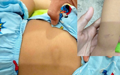 Bình Thuận: Cháu bé 3 tuổi nghi bị bạo hành tại điểm giữ trẻ tự phát