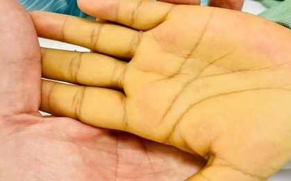 5 dấu hiệu nhận biết sớm ung thư gan không nên bỏ qua