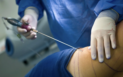 Tạm ngưng hút mỡ bụng tại Bệnh viện Đa khoa Gia Định