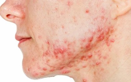 Sắp có vắc xin ngừa mụn trứng cá