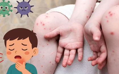 Infographic: Cảnh giác với bệnh Tay Chân Miệng ở trẻ em