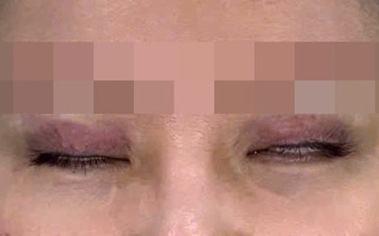 Nữ sinh 22 tuổi mắt không nhắm kín, chảy nước mắt liên tục vì thói quen làm đẹp "bất chấp" của nhiều người