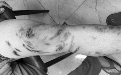 Tổn thương chằng chịt cơ thể do bị sứa chích khi tắm biển