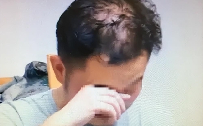 Nam sinh 16 tuổi đã hói nửa đầu vì 1 thói quen khi ngủ người càng trẻ tuổi càng dễ “sa vào bẫy”