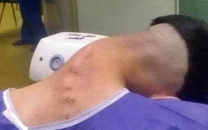Nam thanh niên 23 tuổi mắc 'hội chứng đầu gục' do lạm dụng chất gây nghiện kéo dài