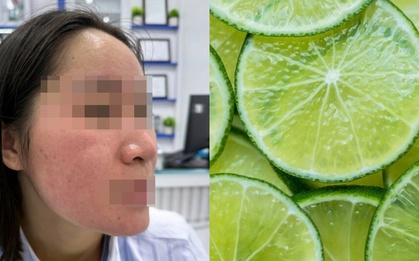 Dùng nước chanh trị mụn theo trên mạng, cô gái trẻ "hỏng mặt"