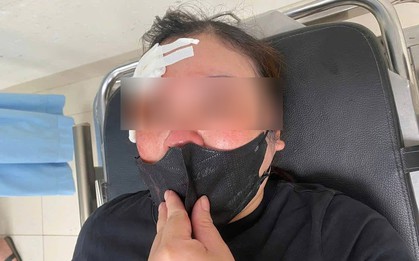 Hà Nội: Người phụ nữ tố bị tài xế ô tô dùng dùi cui đập chảy máu đầu khi đang nghe điện thoại, chưa thể tránh đường