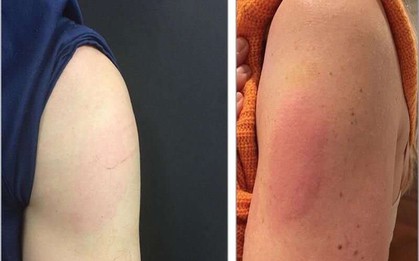 Tiêm vắc xin HPV có phản ứng phụ nào không, khi nào cần gặp bác sĩ?