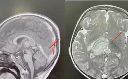 Bé trai hơn 2 tuổi đột quỵ vì bệnh lý hiếm gặp