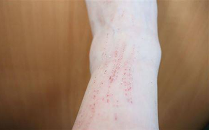 Ăn đồ luộc trong 20 năm, người phụ nữ bị loét da